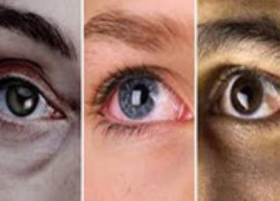 آنچه چشمان شما در مورد سلامتی تان نشان می دهند